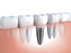 3D Drawing of Human Tooth Implant