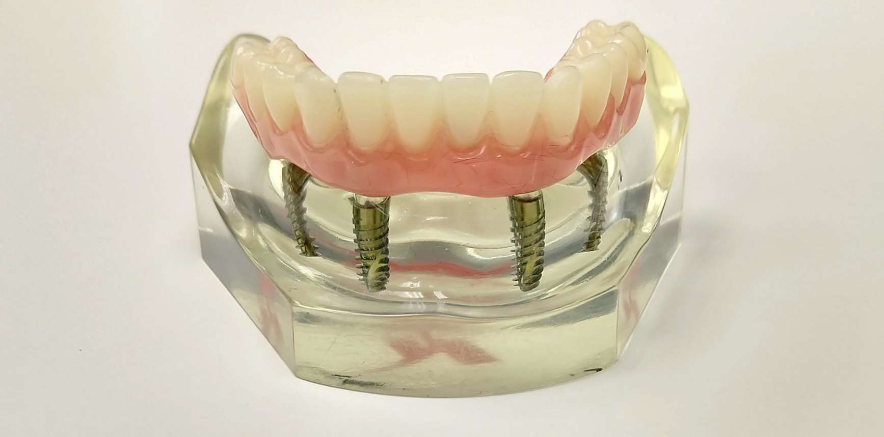 Протез на имплантах при полном отсутствии. Несъемные зубные протезы на 4 имплантах. Несъёмный мостовидный протез челюсти. Протез нижней челюсти на 4 имплантах. Зубной протез верхней челюсти на 4 имплантах.