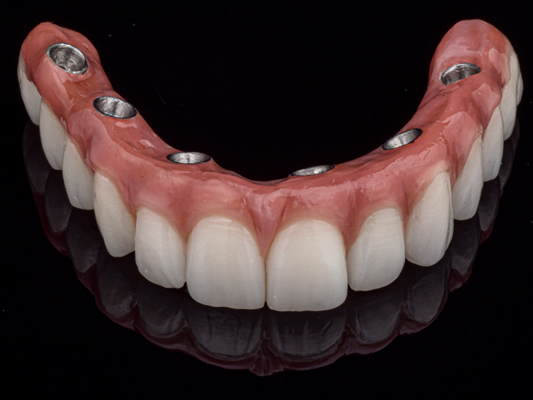 All On Dental Implants: Candidacy, Costs, And Recovery Timeline