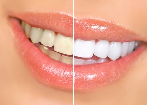 Teeth Whitening Before/After