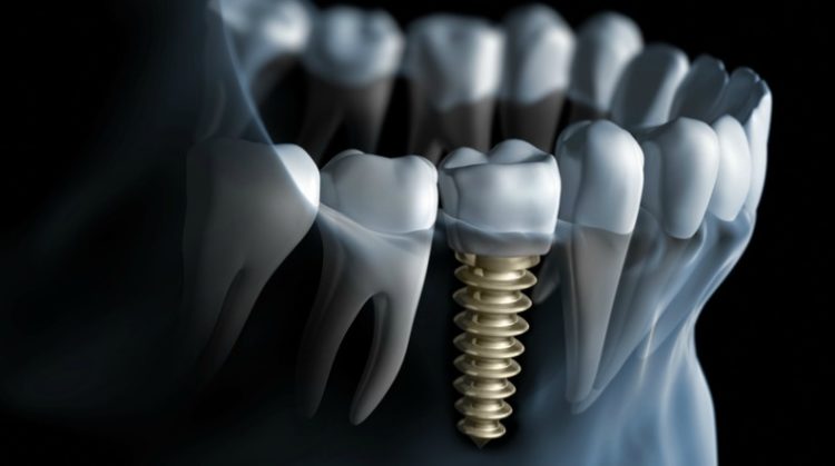 Osteointegration of Dental Implants